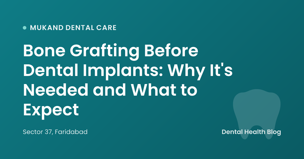 Bone Grafting Before Dental Implants: Why It's Needed and What to Expect